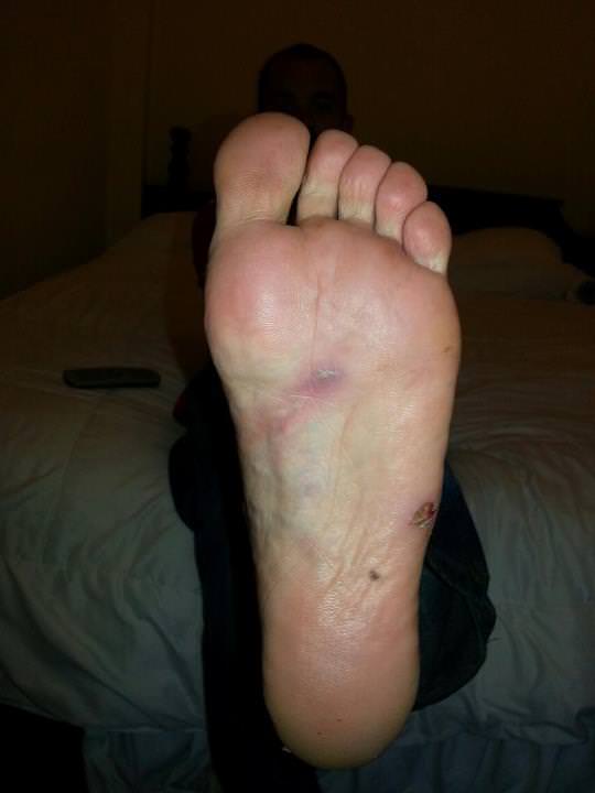 foot infection tubing laos