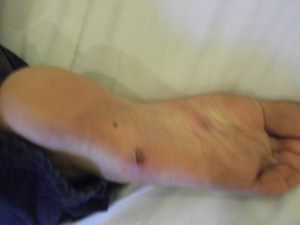 swollen foot vientiane
