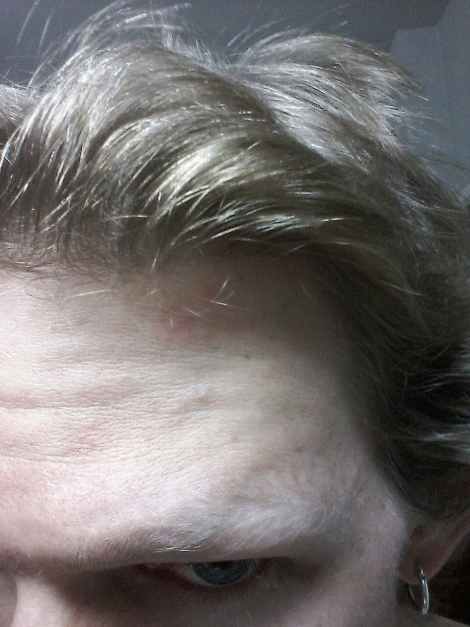 The Day I...Got Loads of Spots on My Head in Senegal
